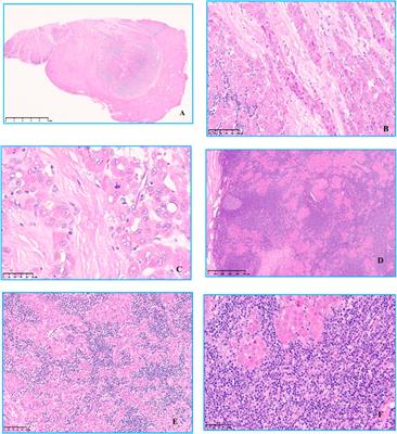 Indolent T-lymphoblastic proliferation with fibrolamellar hepatocellular carcinoma developed after colorectal adenocarcinoma: a case report